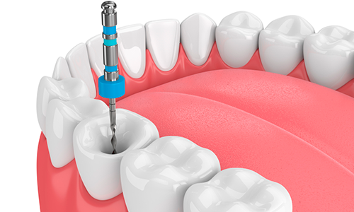 clinica-athos-tratamentos-endodontia