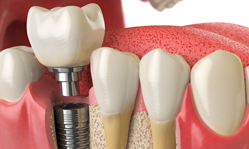 clinica-athos-tratamentos-implantes-dentarios